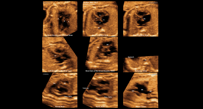 medical diagnostics : 9 fetal heart standard views with 5D Heart Color™