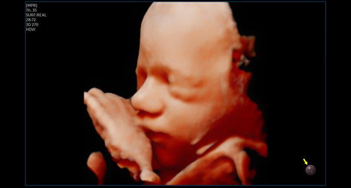 3d imaging : Fetal face with RealisticVue™