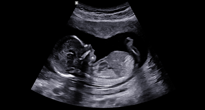 2d images : 1st trimester fetal profile view