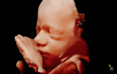 powerful imaging : Fetal face with RealisticVue™