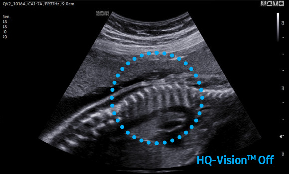 imaging solutions of ob/gyn ultrasound : HQ-Vision™ - off