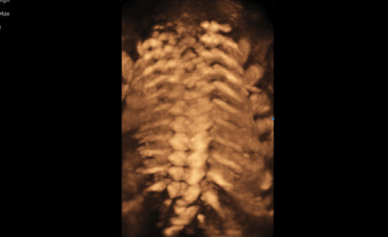 3d imaging of ob gyn ultrasound machines : HDVI™ 