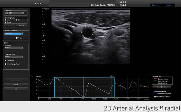 2D Arterial Analysis™ radial