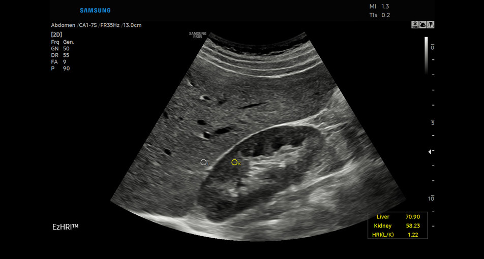 ultrasound for liver EzHRI™ ¹