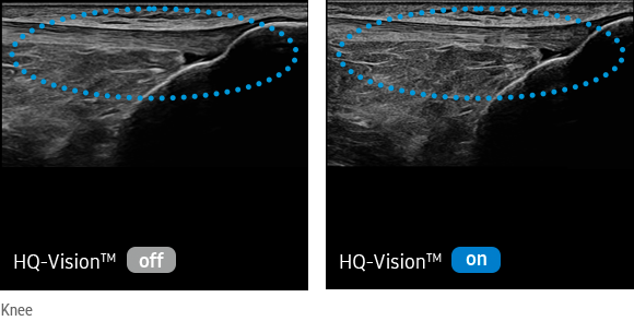 new ultrasound technology HQ-Vision™