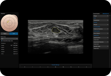 ultrasound for breast : S-Detect™ for Breast 