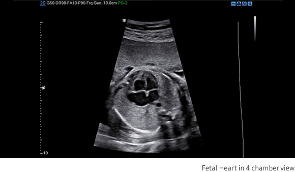 Fetal Heart in 4 chamber view