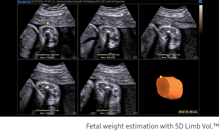 Fetal weight estimation with 5D Limb Vol.™