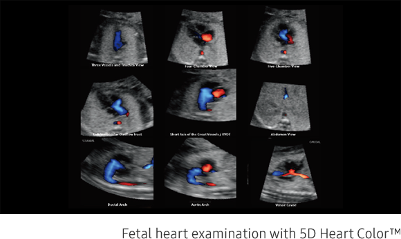 Fetal brain measurement with 5D CNS+™