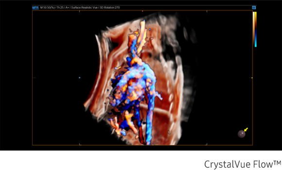 Fetal circulation in CrystalVue Flow™