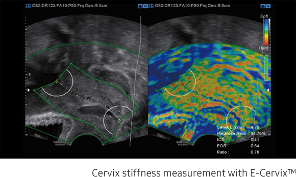 Cervix stiffness measurement with E-Cervix™