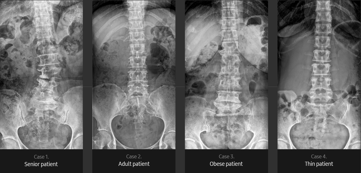 Lumbar Spine AP Sample