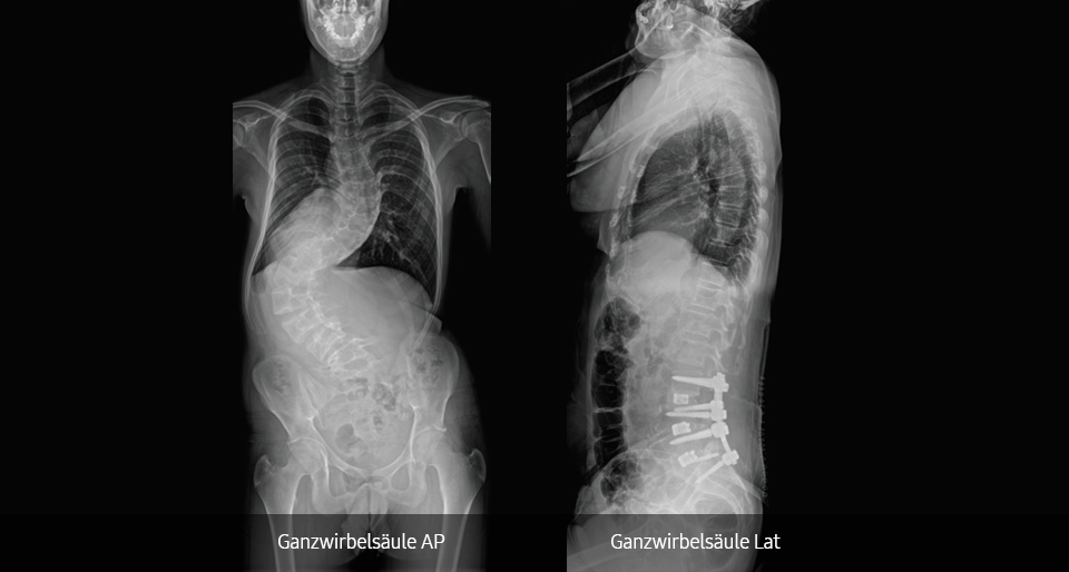 Röntgenaufnahme eines Thorax von vorne und von der Seite; aufgenommen mit dem digitalen Röntgensystem GC85A von Samsung