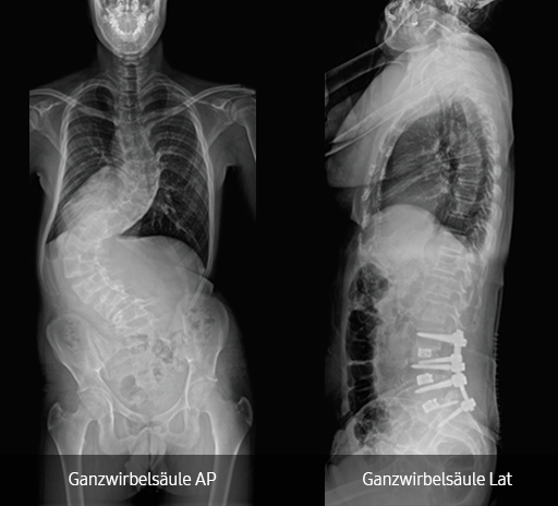 Röntgenaufnahme eines Thorax von vorne und von der Seite; aufgenommen mit dem digitalen Röntgensystem GC85A von Samsung