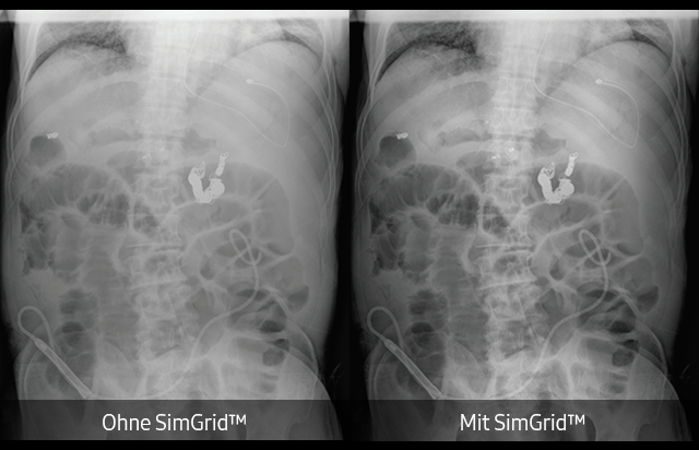 Thorax- Röntgenaufnahme mit dem digitalen Röntgensystem GC85A von Samsung links ohne SimGrid und rechts mit SimGrid