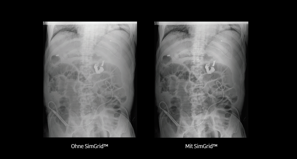 Thorax- Röntgenaufnahme mit dem digitalen Röntgensystem GC85A von Samsung links ohne SimGrid und rechts mit SimGrid