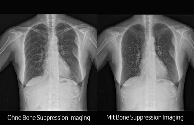 Links Röntgenaufnahme von Thorax ohne Bone Suppression, rechts Aufnahme mit Bone Suppression Funktion von Samsung.