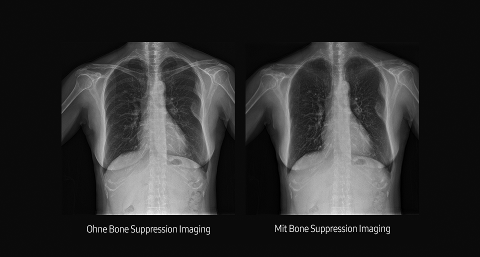 Links Röntgenaufnahme von Thorax ohne Bone Suppression, rechts Aufnahme mit Bone Suppression Funktion von Samsung.