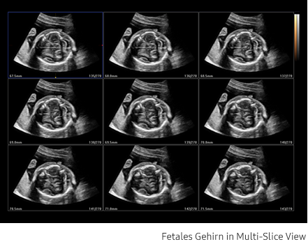 Ultraschallbild fetales Herz aufgenommen mit Ultraschallsystem HS40 von Samsung