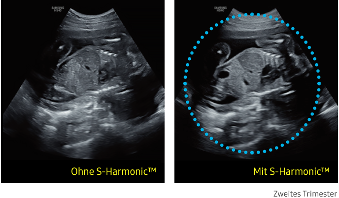 Ultraschallbild links ohne S-Harmonic, rechts mit S-Harmonic