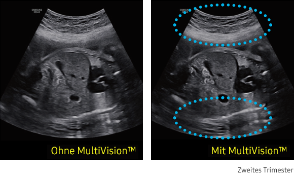 Ultraschallbild links ohne MultiVision, rechts mit MultiVisions