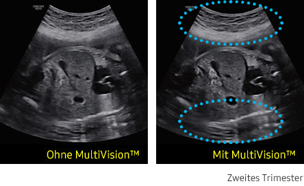 Ultraschallbild links ohne MultiVision, rechts mit MultiVision