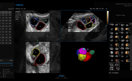 ultrasound obgyn : 5D Follicle™ 